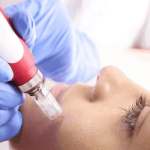 microneedling